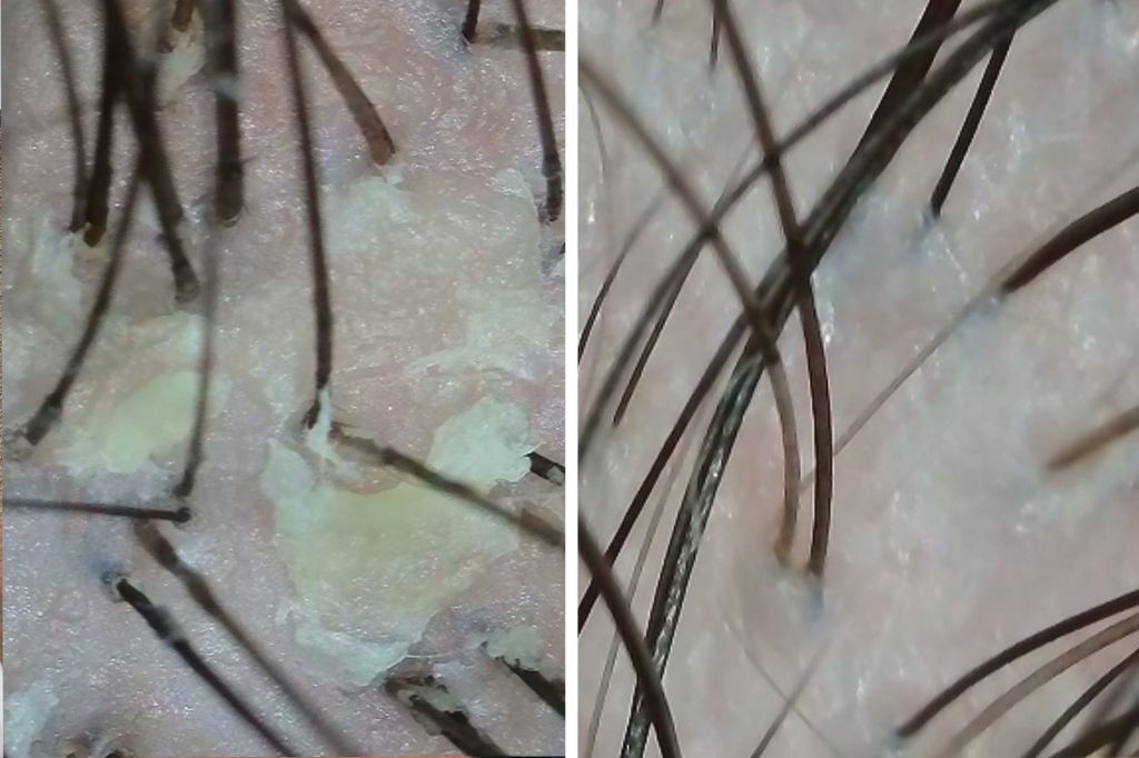Dermatitis Seborreica